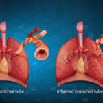 مدیریت بیماری مزمن انسدادی ریه (COPD)